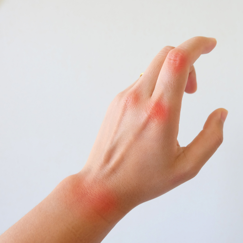 Artritis reumatoide: ¿pueden ayudar los suplementos de omega-3?