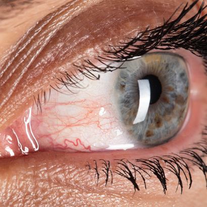 El síndrome del ojo seco mejora con omega-3 y omega-6 tomados durante 6 meses